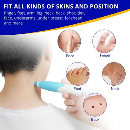 Painless Skin Tag & Wart Removal Kit