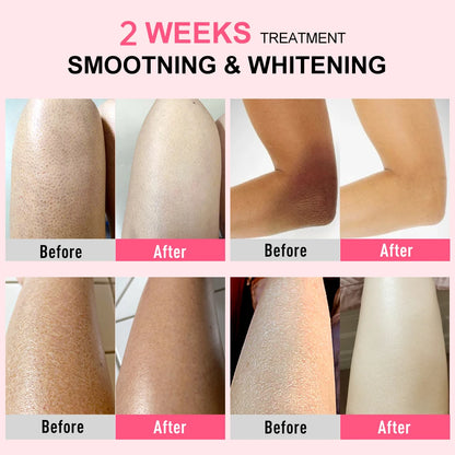 Chicken Skin Removal Treatment Keratosis Pilaris Lotion Moisturizer Whitening Creams 60g