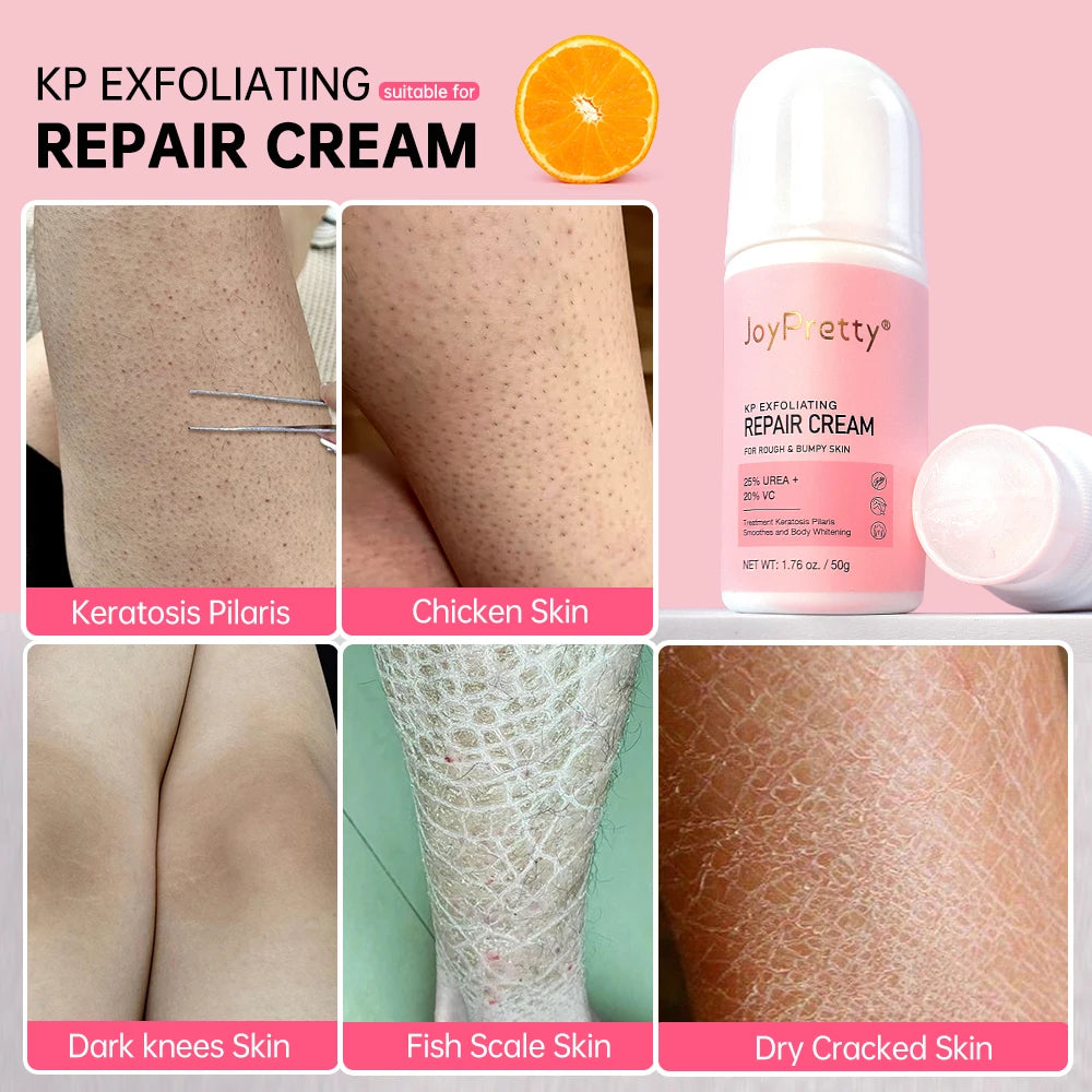 Chicken Skin Removal Treatment Keratosis Pilaris Lotion Moisturizer Whitening Creams 60g