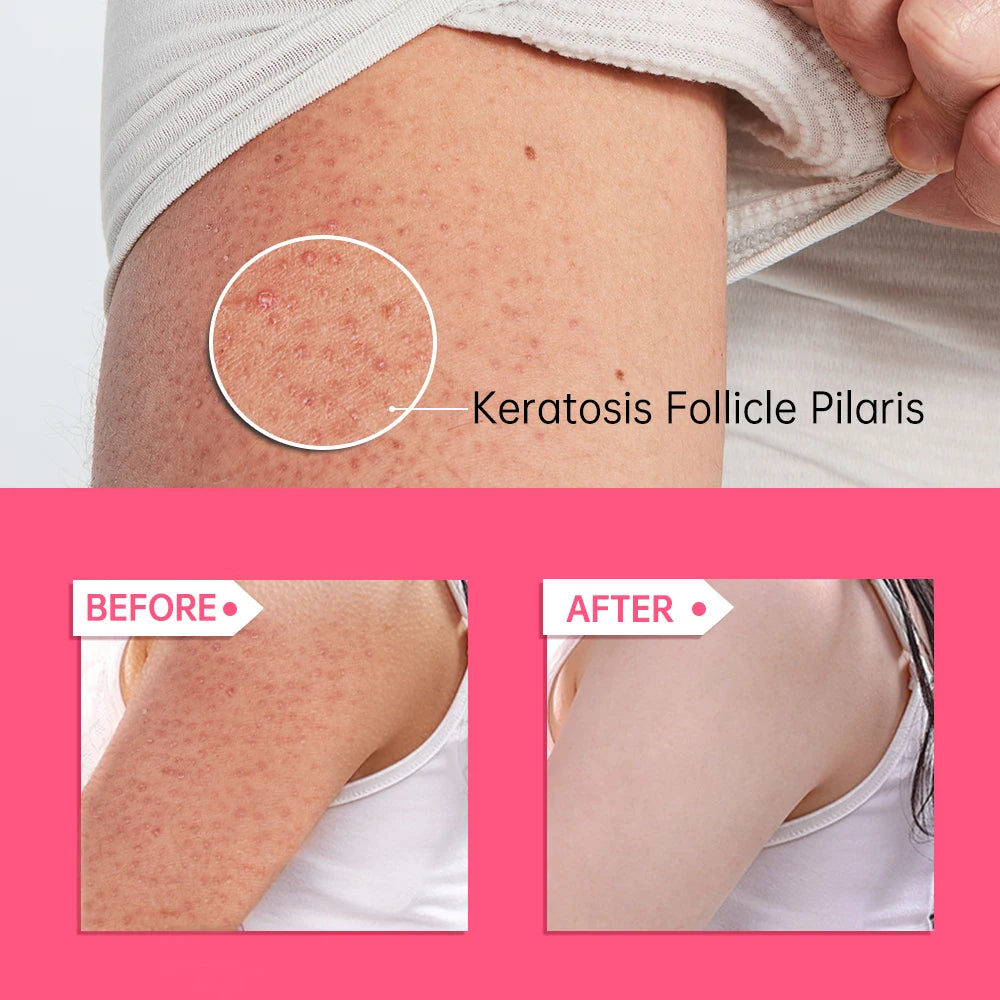 Chicken Skin Removal Treatment Keratosis Pilaris Lotion Moisturizer Whitening Creams 60g