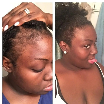 Anti Alopecia Oil Hair Growth