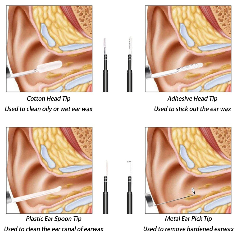 Smart Visual Medico Otoscopio Ear Cleaner