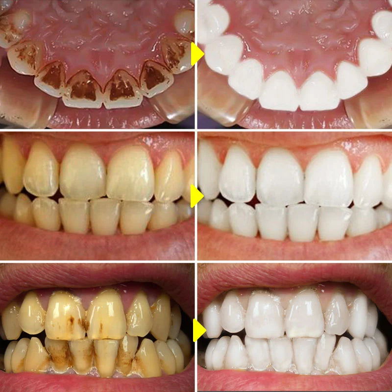 Teeth Whitening Essence Remove Against Dental Caries Plaque Stains Serum Fresh Breath Oral Hygiene Dental Tooth Cleaning Tools