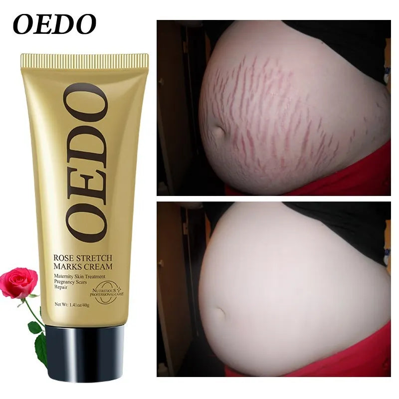 Rose Stretch Mark Cream: Postpartum & Anti-Aging Solution