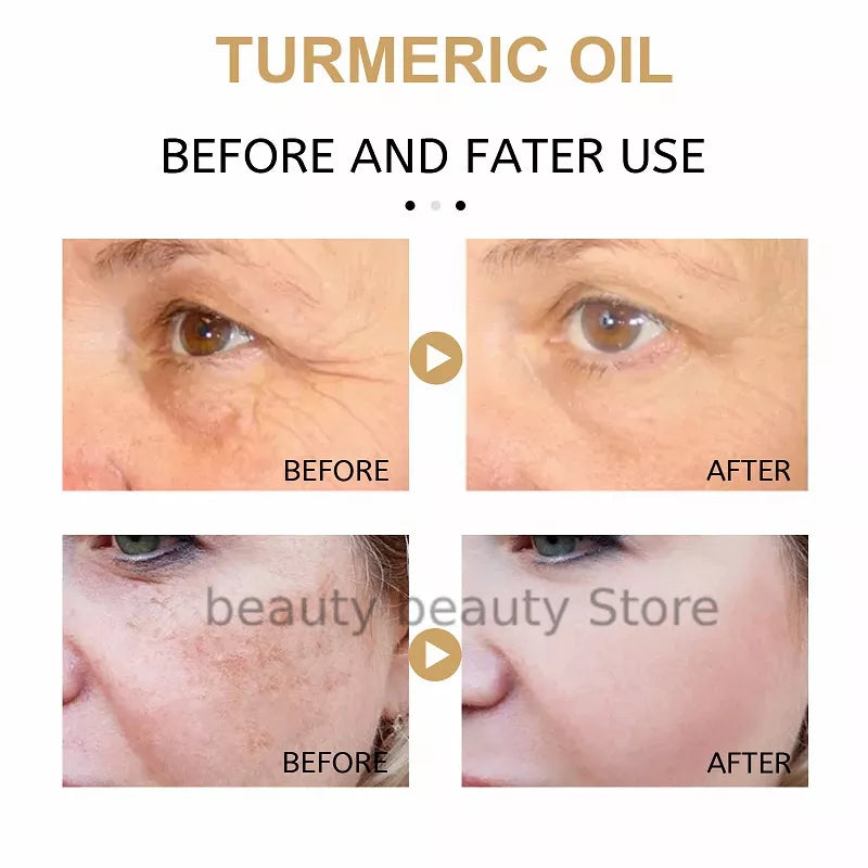 Turmeric Oil Skin To Lightening Acne Dark Patches