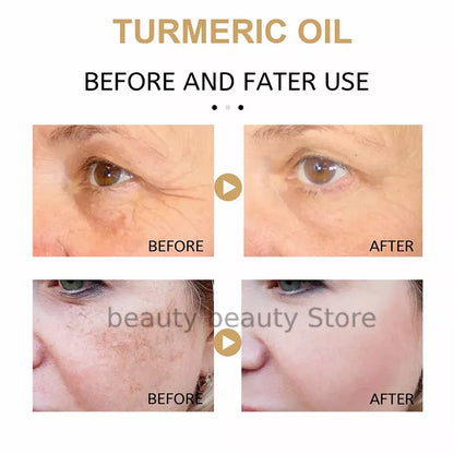 Turmeric Oil Skin To Lightening Acne Dark Patches